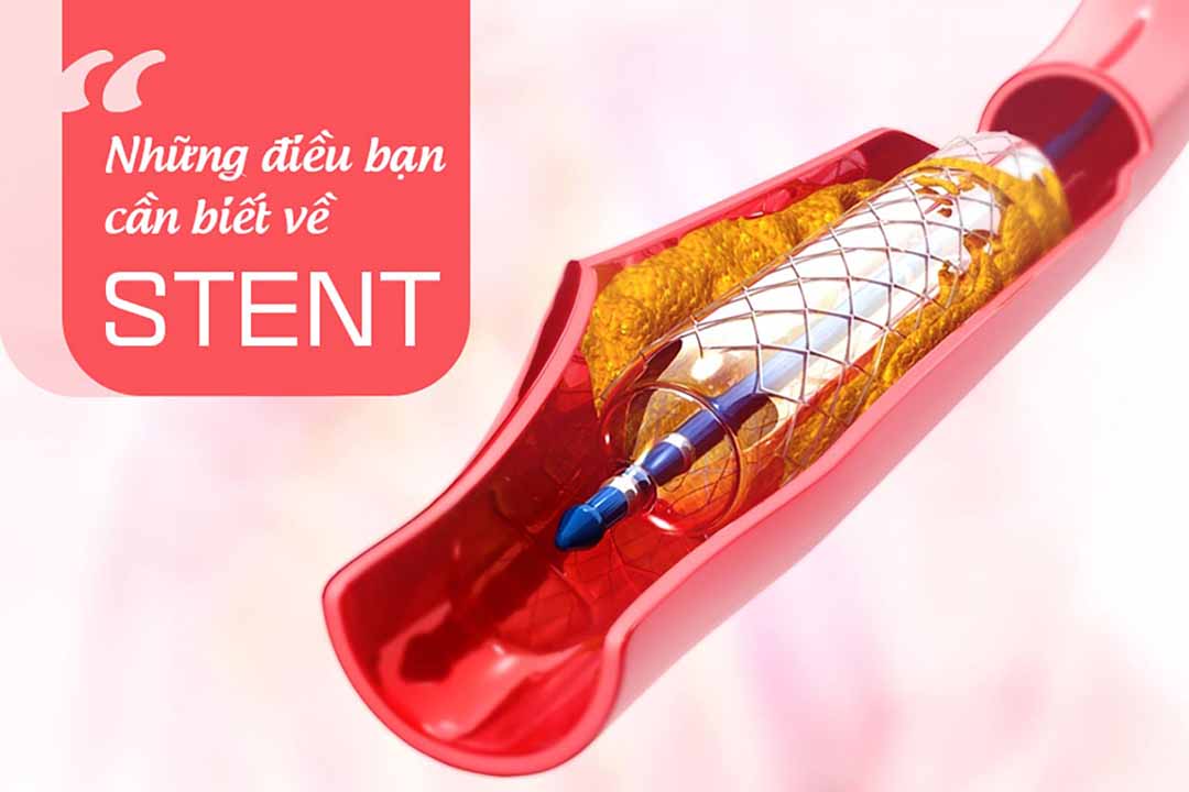 Những điều bạn cần biết về Stent