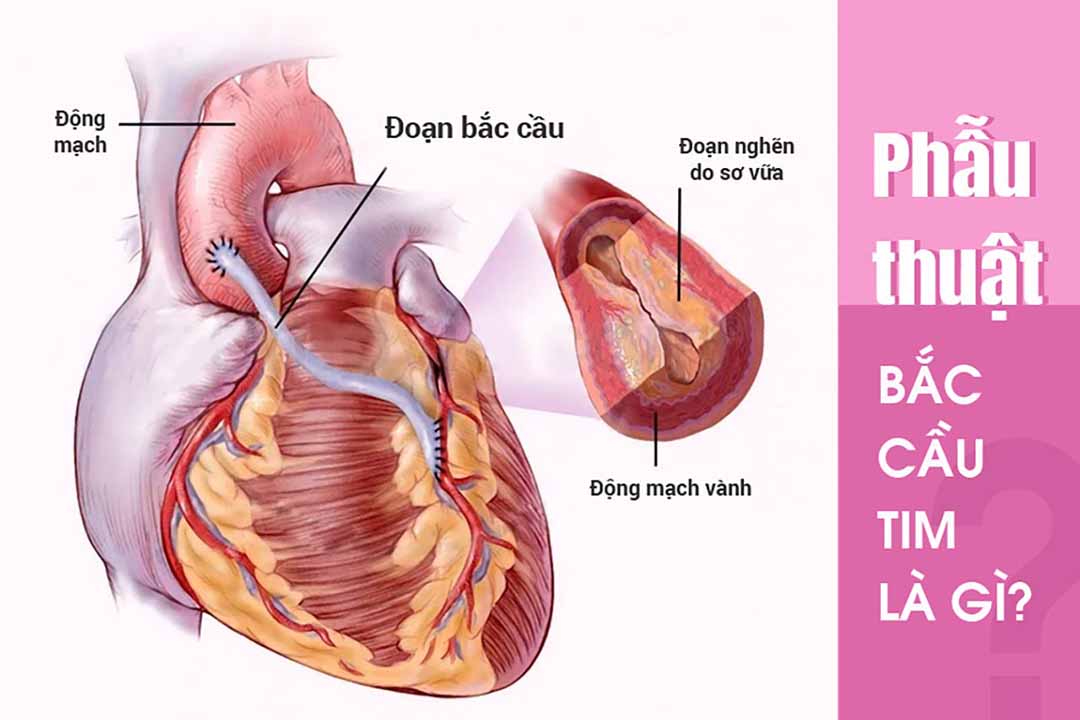 Phẫu thuật bắc cầu tim là gì?