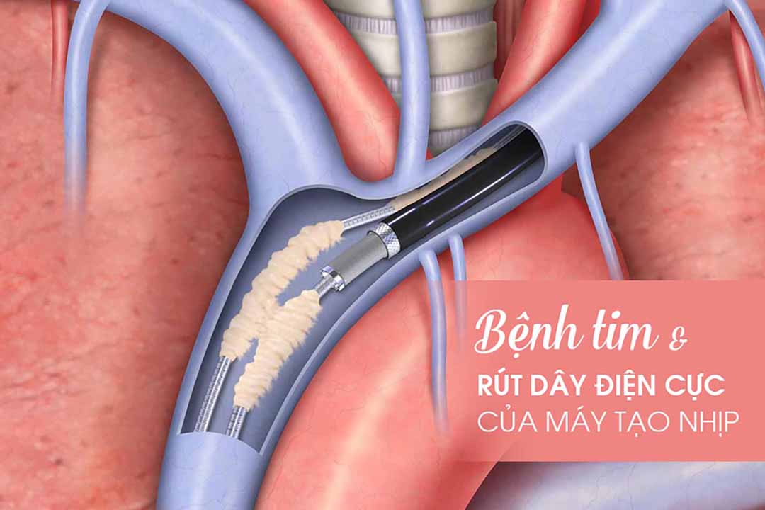 Bệnh tim và Rút dây điện cực của máy tạo nhịp tim