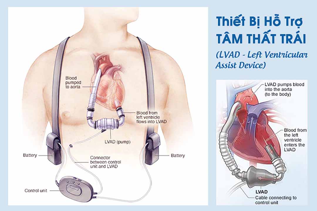 Bệnh tim và thiết bị hỗ trợ tâm thất trái (LVAD - Left Ventricular Assist Device)