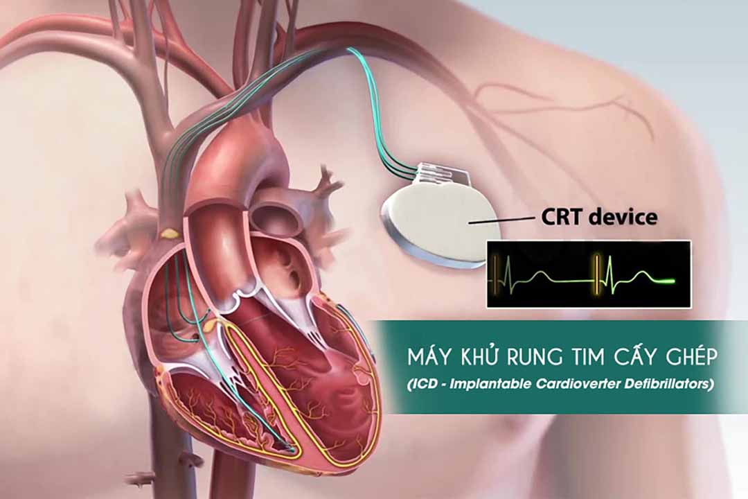 Nhịp tim bất thường và Máy khử rung tim cấy ghép (ICD - Implantable Cardioverter Defibrillators)