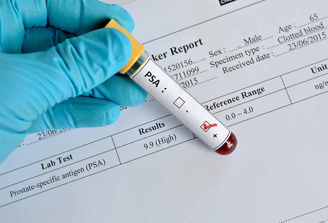 Xét nghiệm PSA (kháng nguyên đặc hiệu tuyến tiền liệt - Prostate specific antigen) 