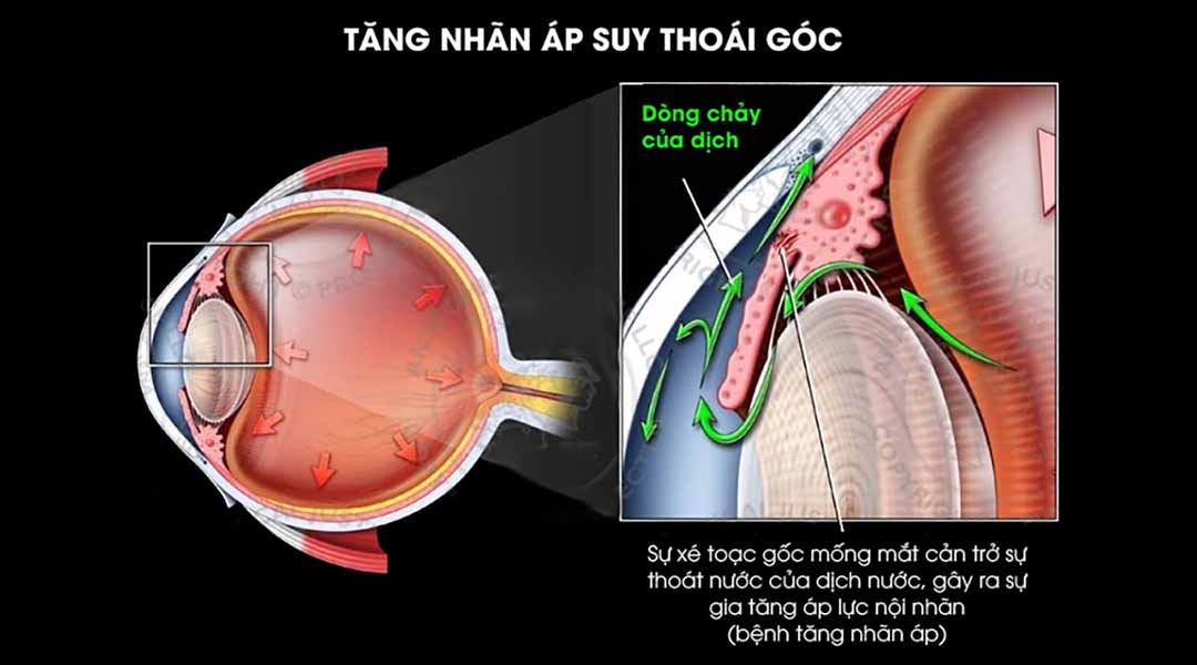 Bệnh tăng nhãn áp suy thoái góc là gì?