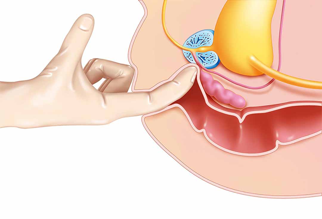 Khám trực tràng kỹ thuật số - Bác sĩ sẽ đặt một ngón tay đã đeo găng và bôi trơn vào trực tràng, để phát hiện ra khối u.