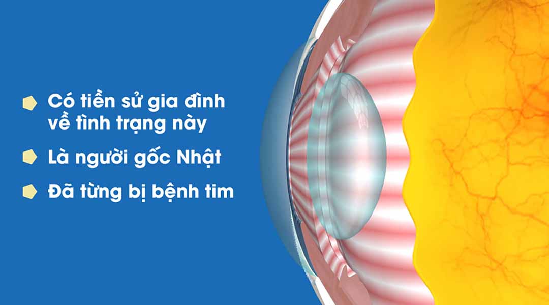 Khả năng mắc bệnh tăng nhãn áp bình thường cao hơn. 