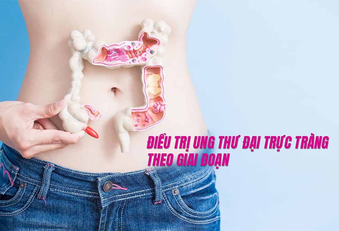 Điều trị ung thư đại trực tràng theo giai đoạn là gì?