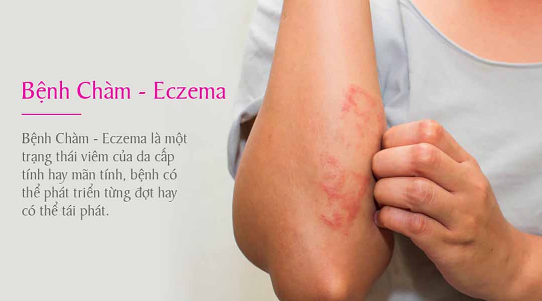 Bệnh Chàm - Eczema