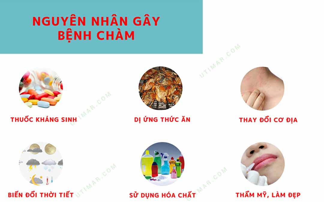 Những nguyên nhân gây ra bệnh Chàm - Eczema.