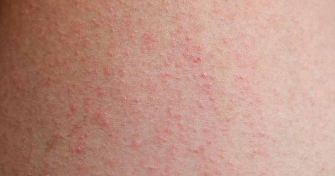 Bệnh Chàm - Eczema là một trạng thái viêm của da cấp tính hay mãn tính.