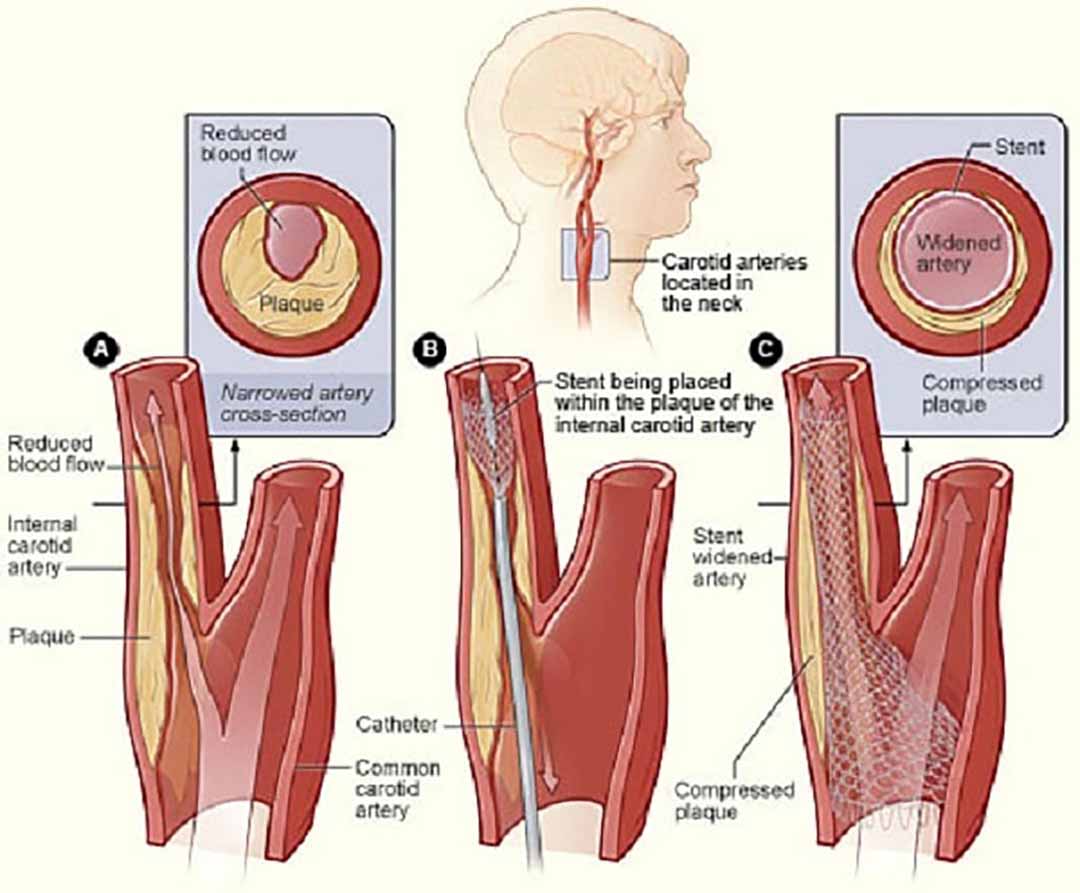 Động mạch cảnh xuất phát từ động mạch chủ ở trong ngực đi lên 2 bên cổ và sau đó cho nhánh vào não nằm trong sọ.