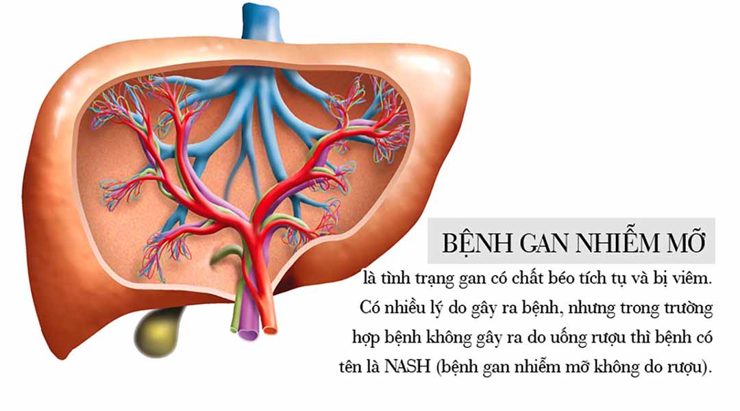 Bệnh Gan Nhiễm Mỡ