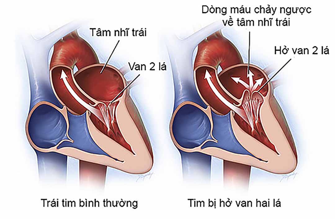 Bệnh Hẹp eo động mạch chủ là dị tật tim bẩm sinh xuất hiện từ trước khi trẻ ra đời.