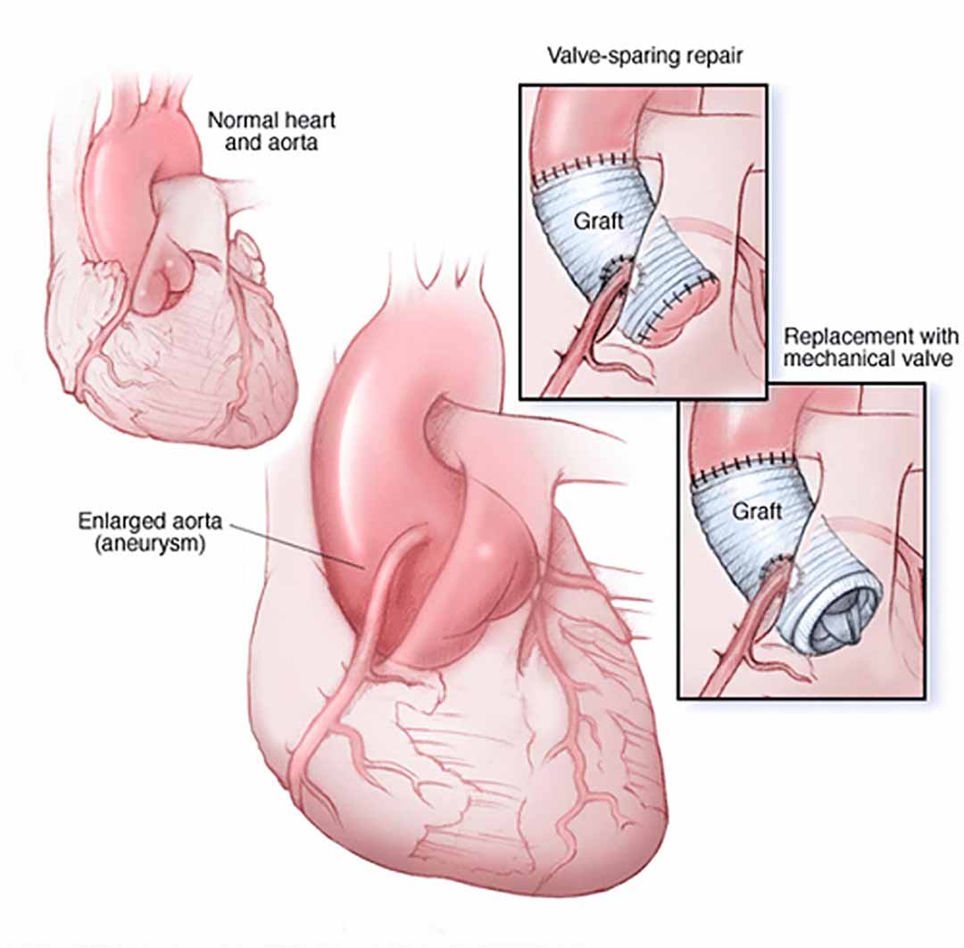 Phương pháp phẫu thuật thường được bác sĩ tư vấn cho người bệnh.