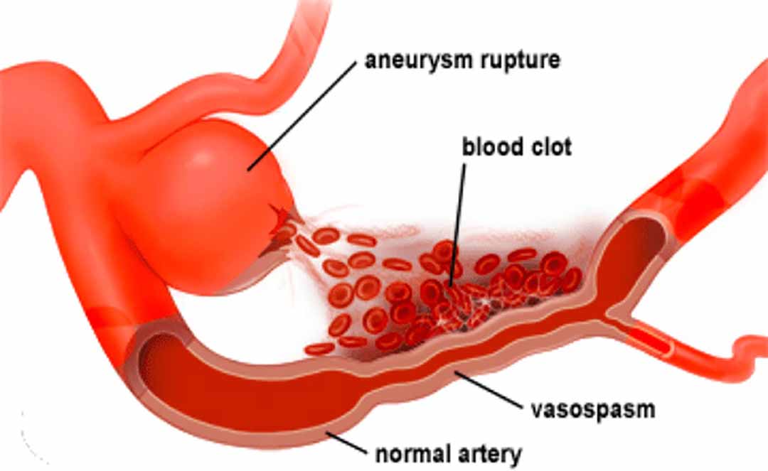 Nguyên nhân phổ biến nhất là xơ vữa động mạch và tăng huyết áp.