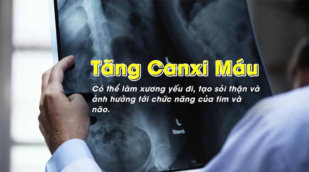 Bệnh Tăng Canxi Máu