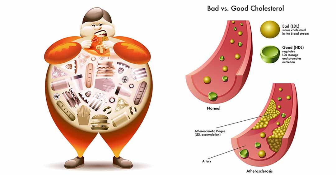 Nguy cơ cholesterol máu ở người đó tăng cao vì có một đột biến trong gen.