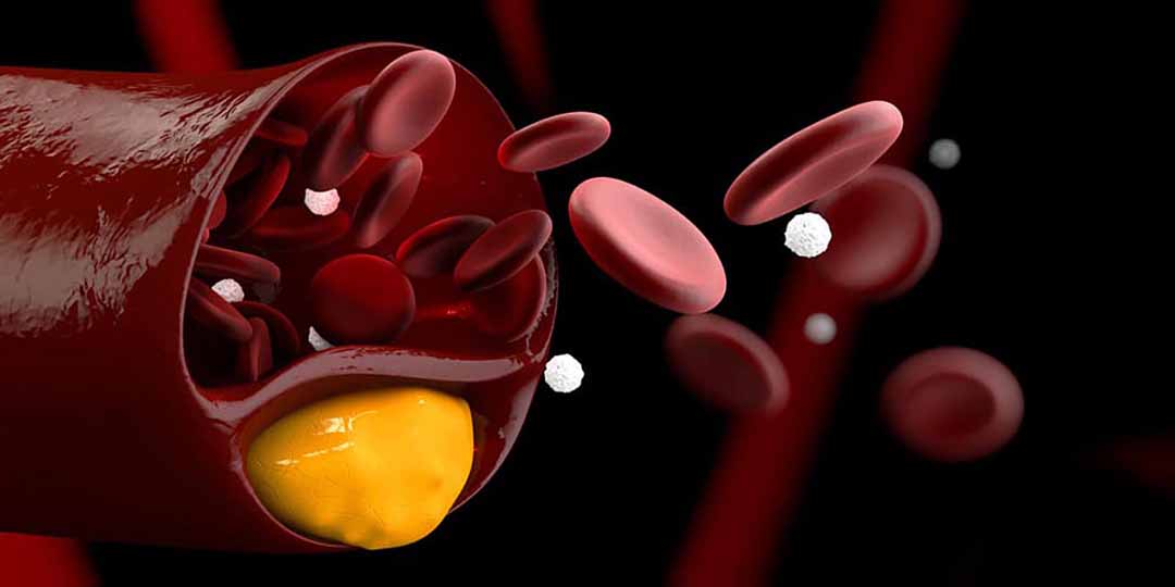 Tình trạng ảnh hưởng tới quá trình xử lý cholesterol trong cơ thể.