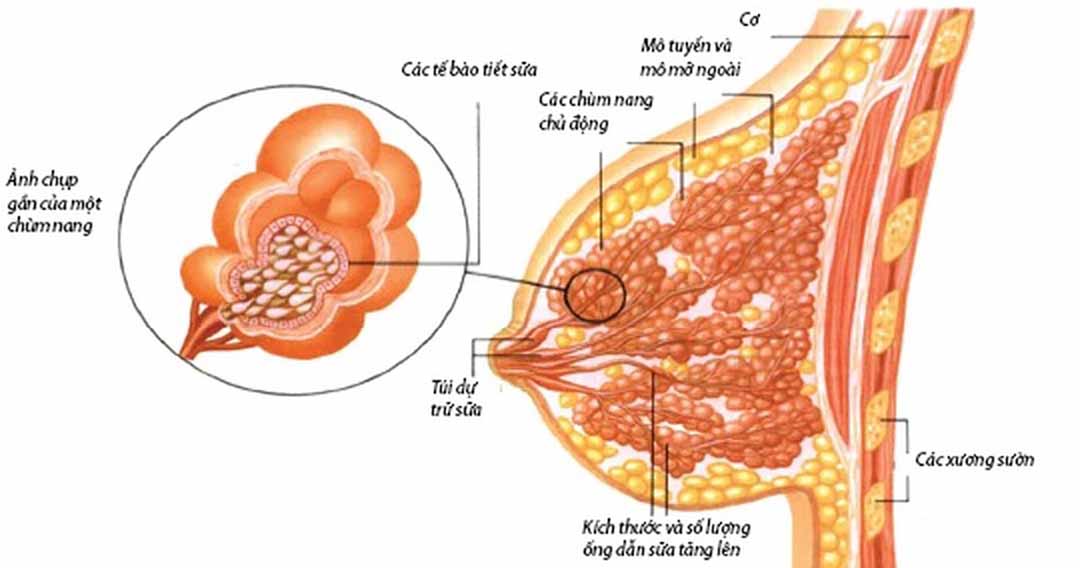 U nang tuyến vú là sự xuất hiện bất thường của một hay nhiều túi chứa dịch trong vú.