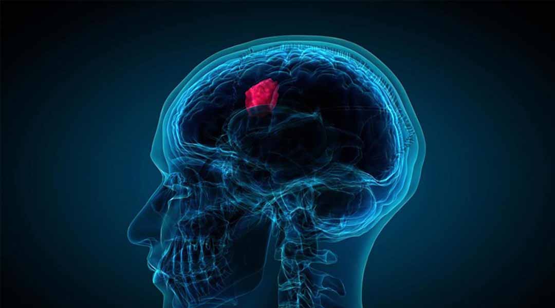 Bệnh U Não - Brain Tumor