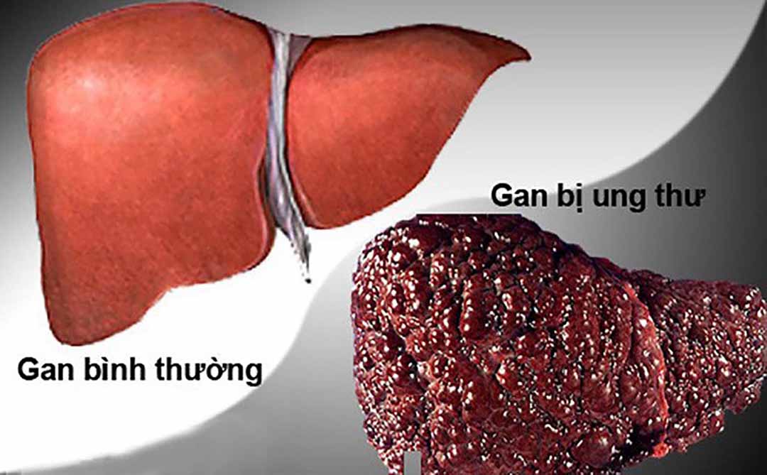 Ung thư gan là ung thư bắt đầu trong tế bào gan.