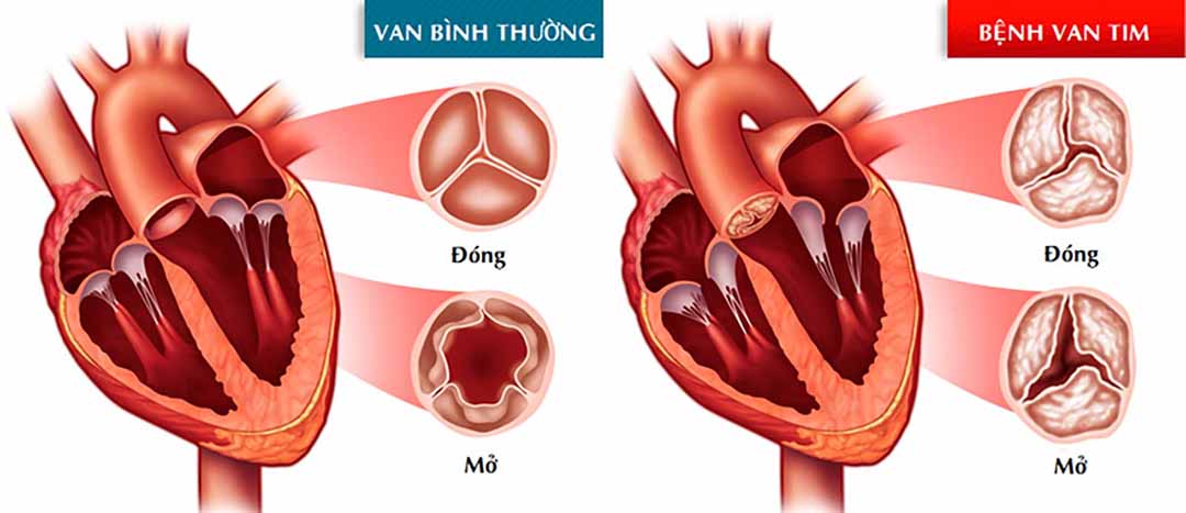 Xảy ra khi các lá van trong tim không còn hoạt động hiệu quả do một số lý do nào đó.