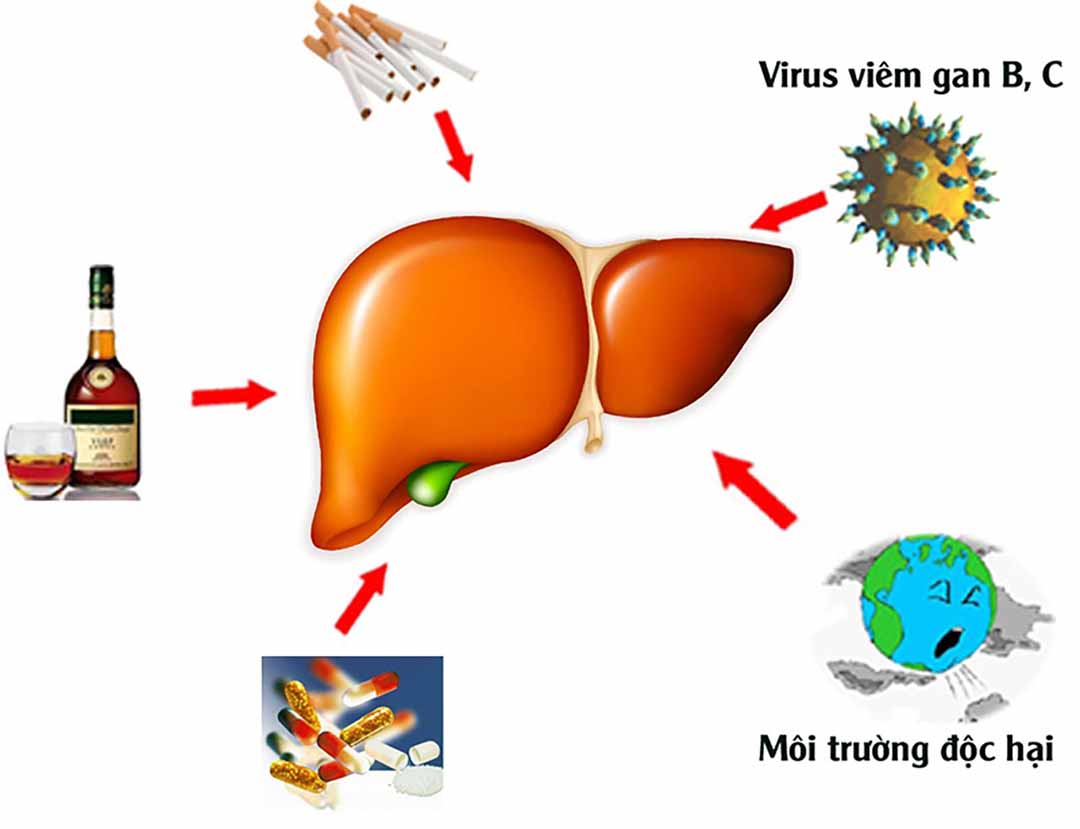 Virus, rượu bia, ứ mật và nhiễm độc là nguyên nhân gây xơ gan.