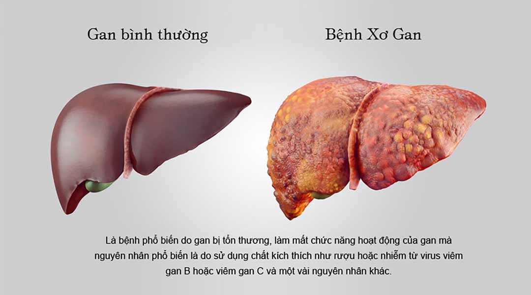 Bệnh Xơ Gan