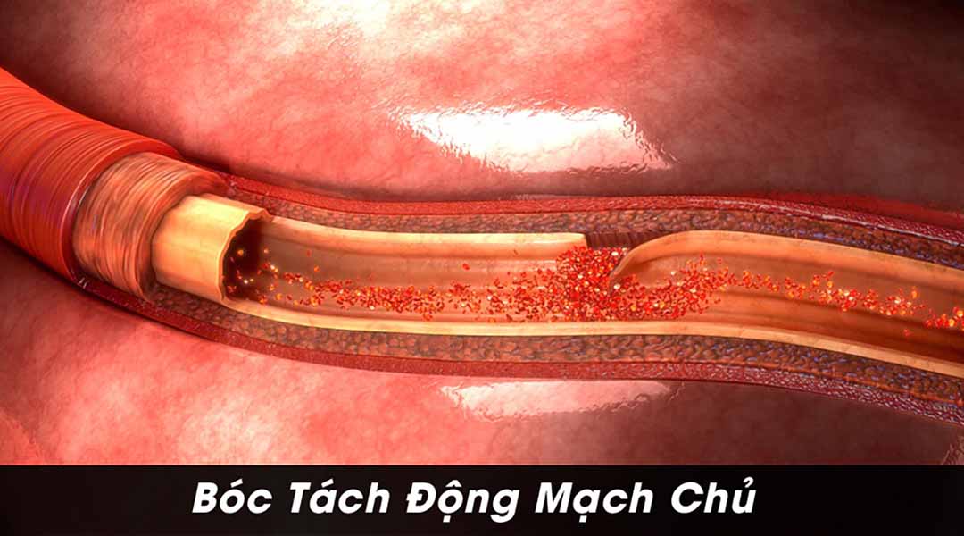 Bóc Tách Động Mạch Chủ 