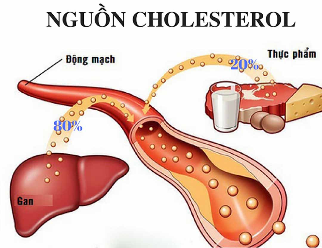 Cholesterol cao là tình trạng nồng độ cholesterol trong cơ thể cao hơn mức bình thường.