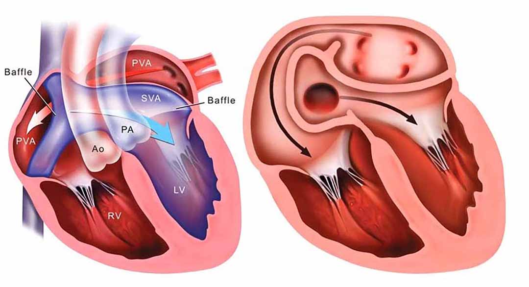 Tình trạng 2 động mạch chính của tim là động mạch chủ và động mạch phổi bị hoán đổi vị trí với nhau.