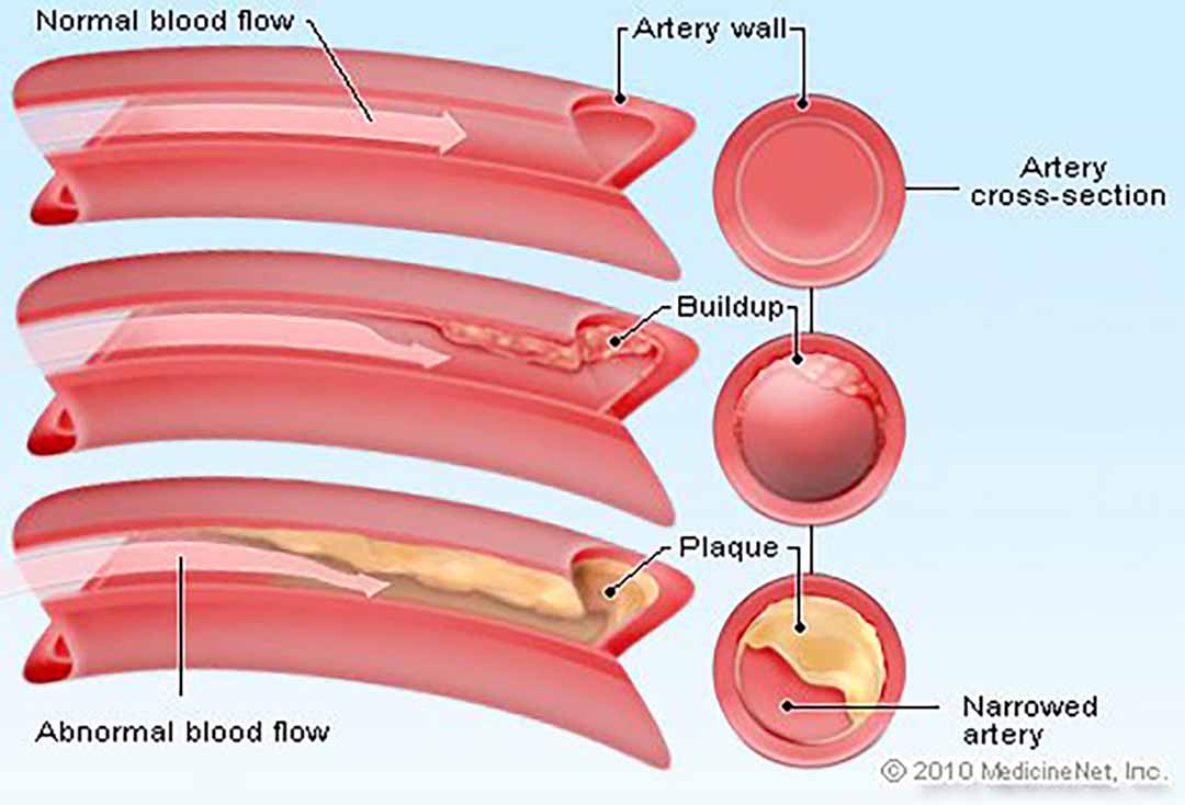 Cholesterol lắng đọng, làm hẹp động mạch.