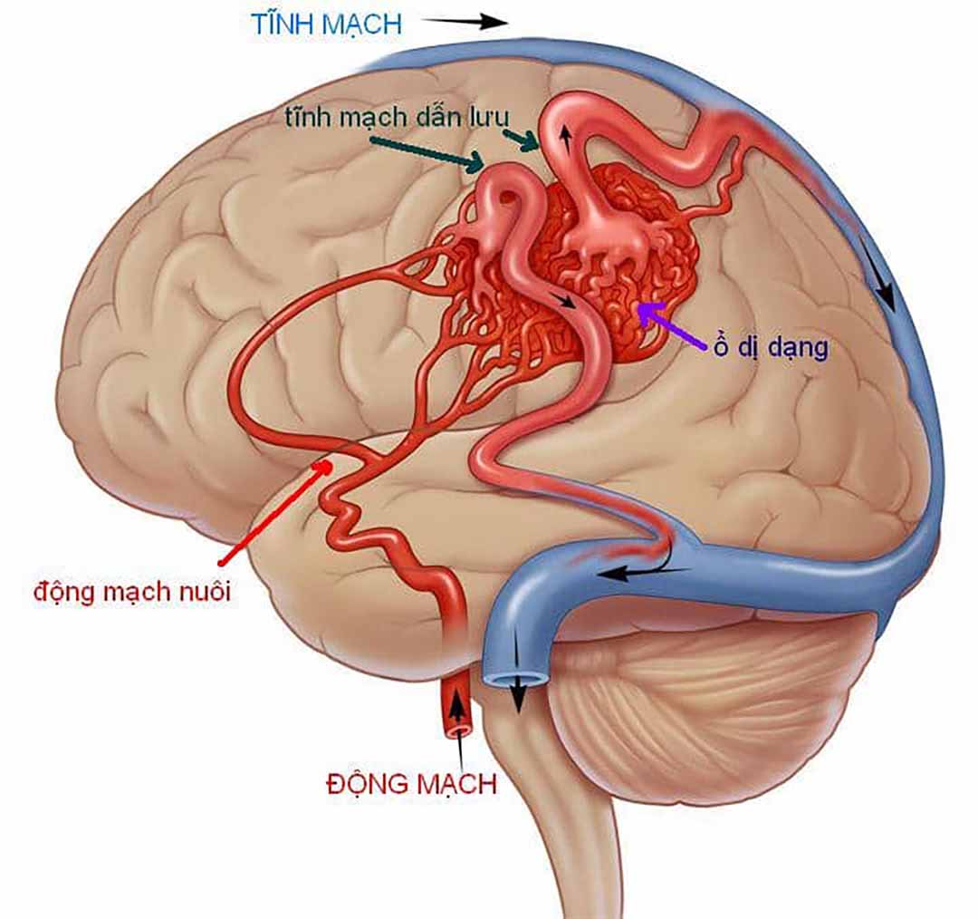 Một rối loạn của mạch máu liên kết giữa động mạch và tĩnh mạch não.