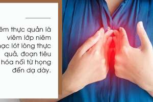 Bệnh Viêm Thực Quản