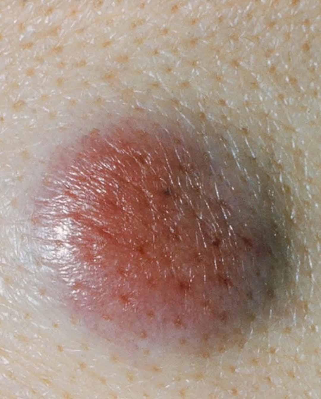 Ung thư tế bào gai thường xuất hiện ở vùng da có tiếp xúc với ánh nắng mặt.