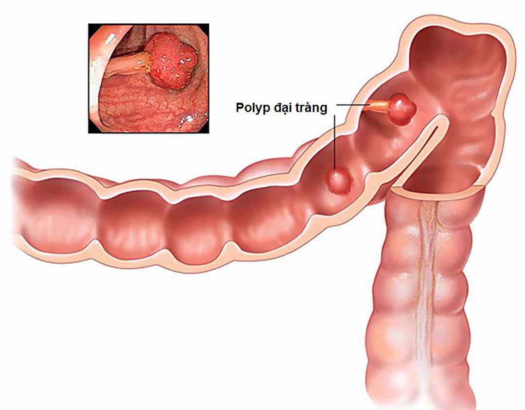 Nếu để thời gian dài thì chính những polyp đó sẽ có nguy cơ rất cao phát triển trở thành ung thư ruột già.