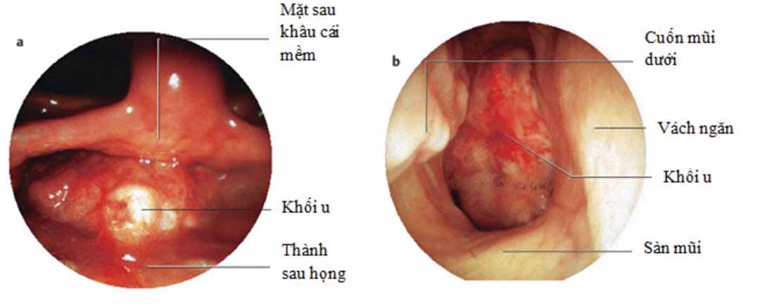 òm họng là phần cao nhất của họng, có hình vòm.