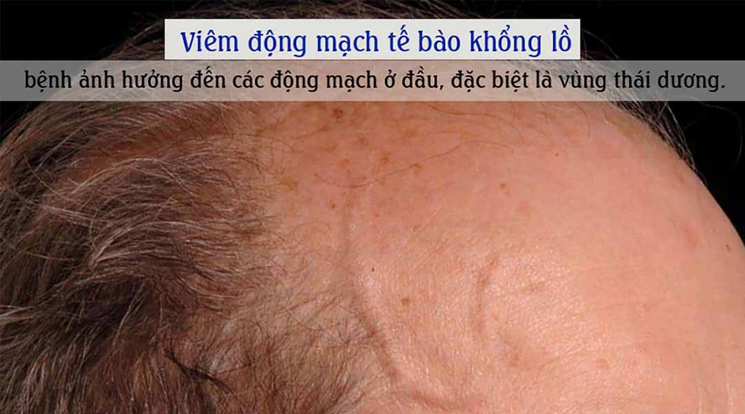 Viêm Động Mạch Tế Bào Khổng Lồ