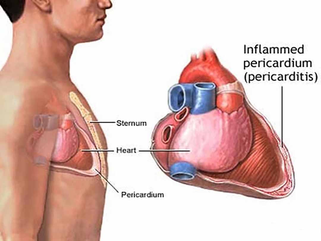 Viêm màng ngoài tim có thể diễn biến từ từ sau một cơn đau tim.