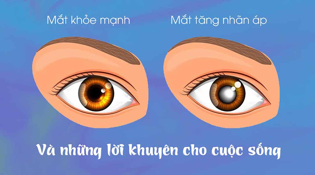 Lời khuyên cho cuộc sống với người mắc bệnh tăng nhãn áp