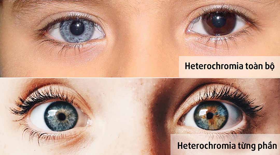 Hình ảnh cho thấy 2 loại Heterochromia toàn bộ và từng phần.