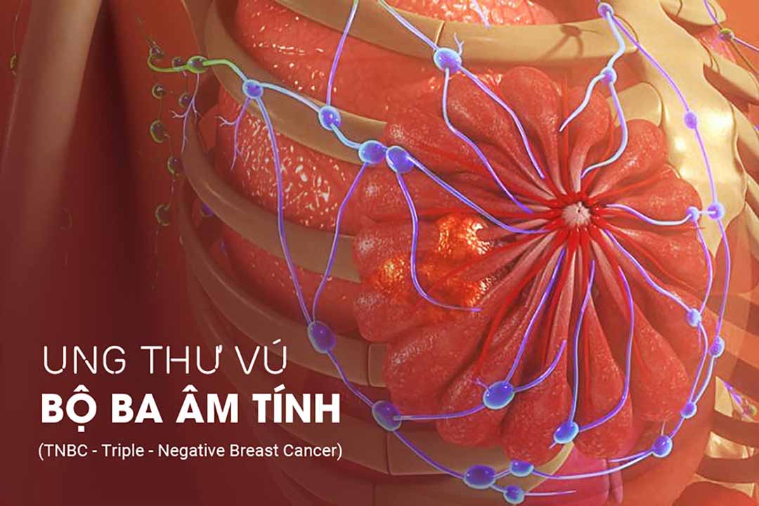 Ung thư vú bộ ba âm tính (TNBC - Triple - Negative Breast Cancer)