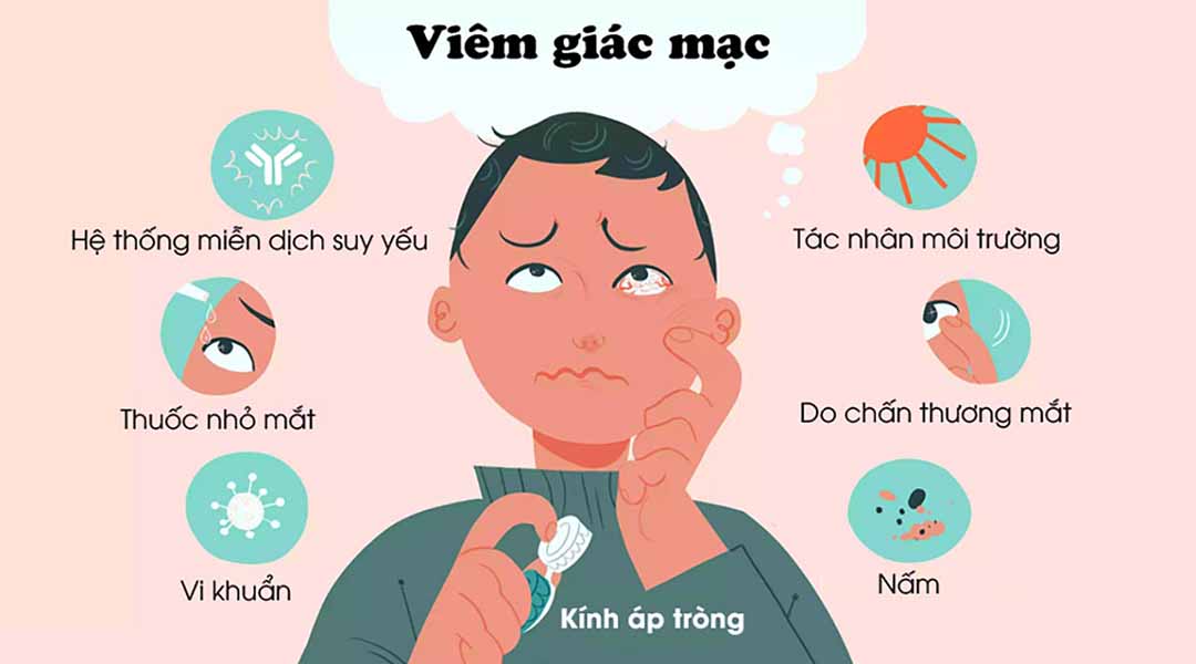 Viêm giác mạc là gì?