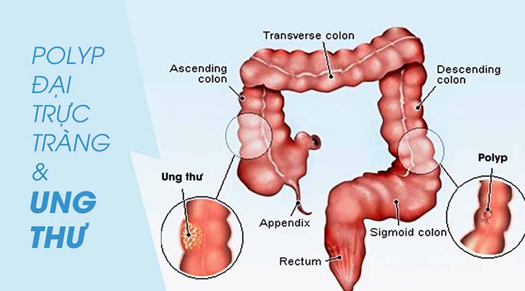 Polyp đại trực tràng và ung thư