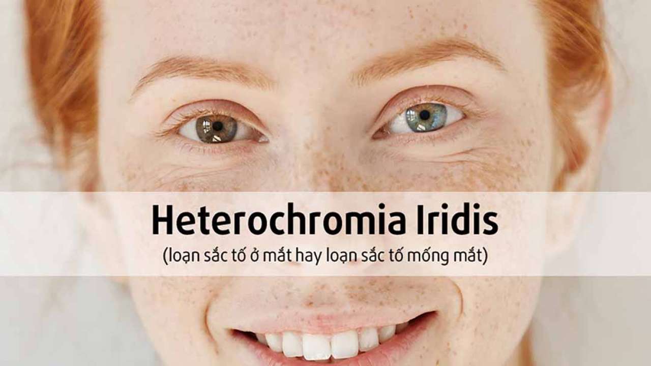 Heterochromia là gì