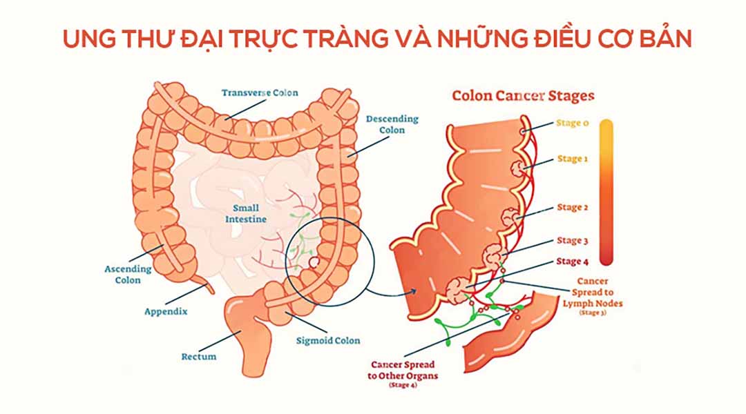 Tìm hiểu ung thư đại trực tràng và những điều cơ bản