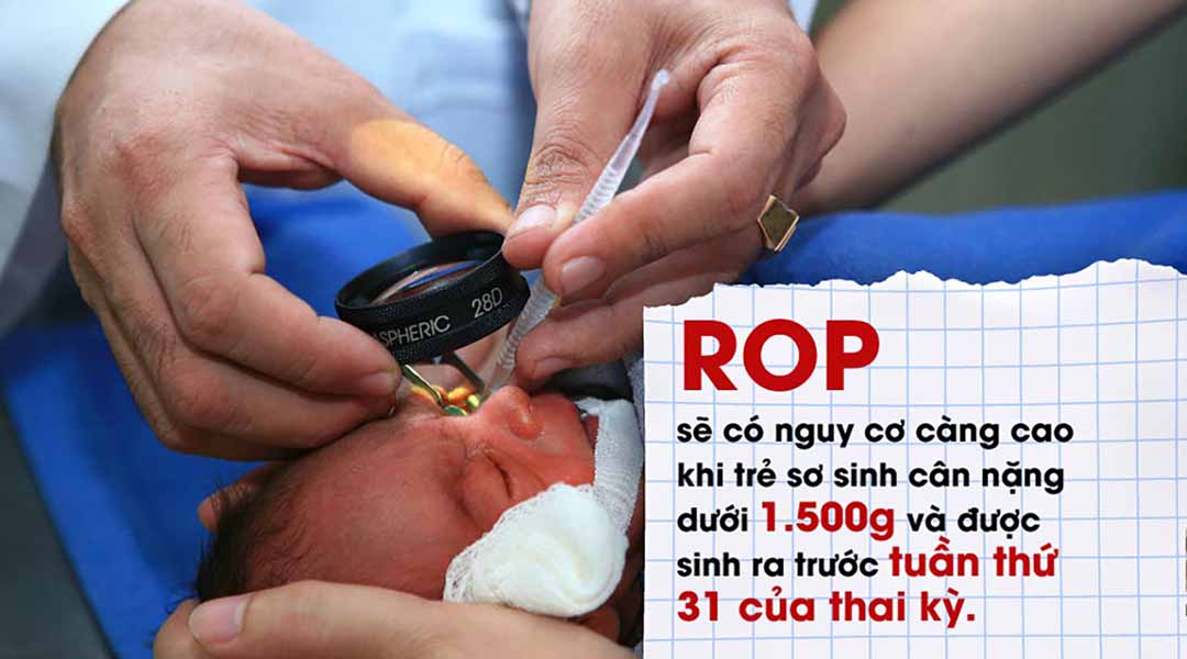 Bệnh lý võng mạc ở trẻ do sinh non (ROP)