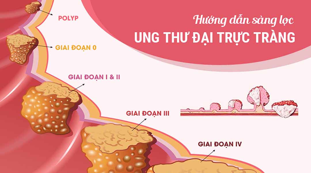 Hướng dẫn sàng lọc ung thư đại trực tràng