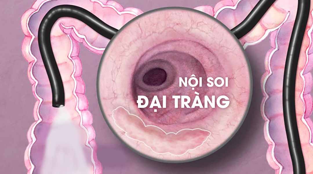 Nội soi đại tràng: Những điều cần biết