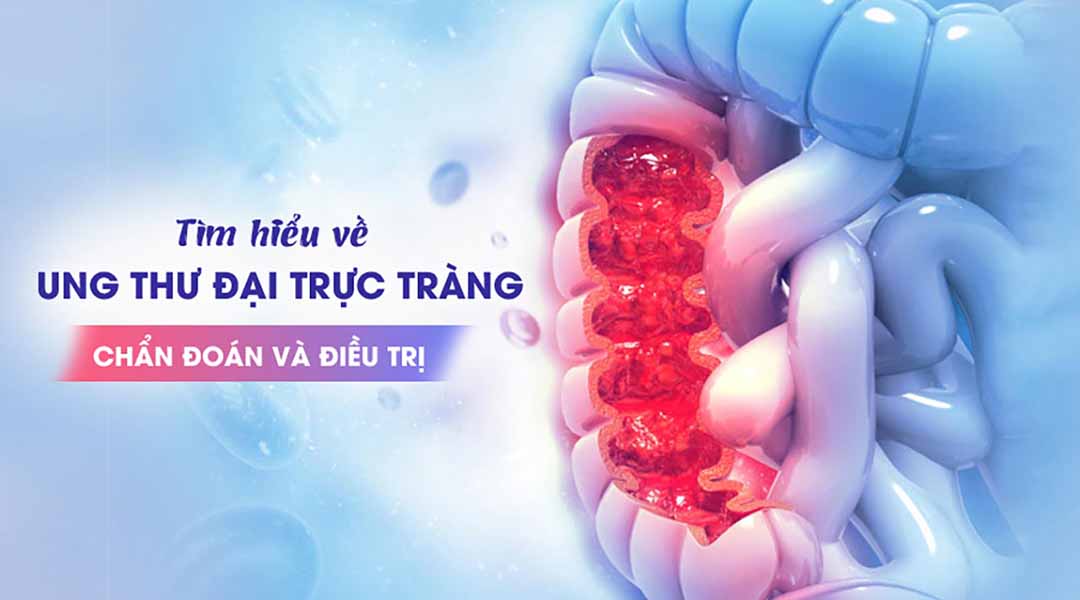 Tìm hiểu về ung thư đại trực tràng - Chẩn đoán và điều trị