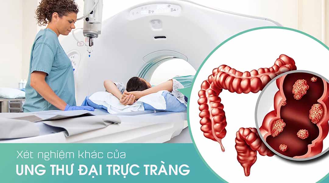 Những xét nghiệm khác của ung thư đại trực tràng